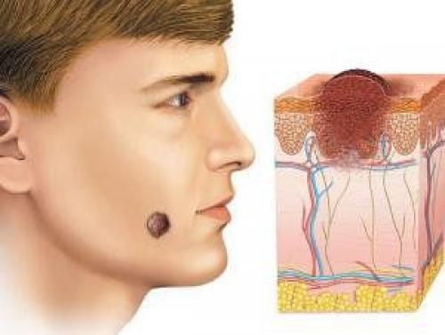 Опасные и неопасные родинки: как отличить их и защитить себя 04