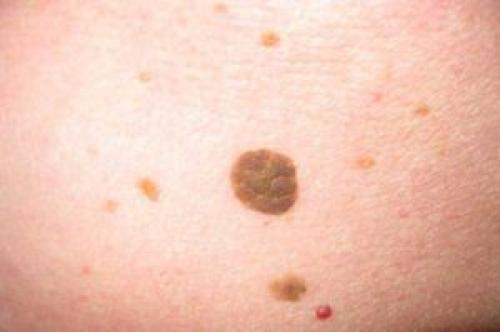 Опасные и неопасные родинки: как отличить их и защитить себя 03