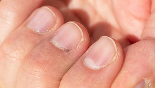 Болезненные доброкачественные опухоли кончика пальца и ногтя. Классификация и симптомы паронихии 01 Болезненные доброкачественные опухоли кончика пальца и ногтя. Классификация и симптомы паронихии 01