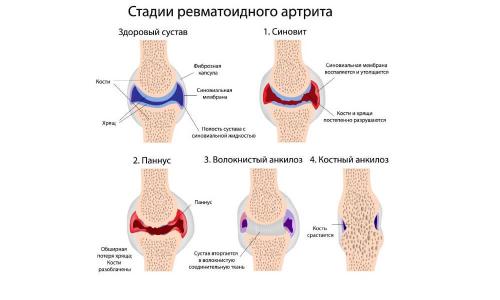 Есть ли противопоказания для приема желатина при артрозе. Польза желатина для суставов