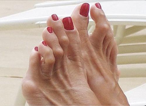 Деформация мизинца на ноге. Другие деформации 2, 3 и 4-го пальцев стопы