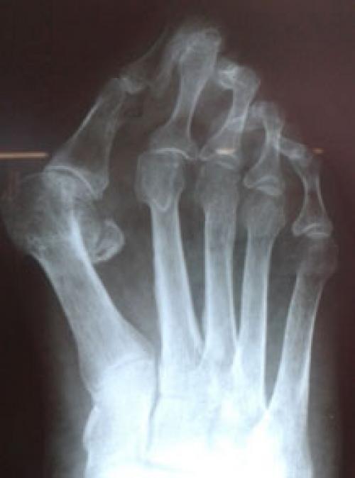 Деформация мизинца на ноге. Другие деформации 2, 3 и 4-го пальцев стопы