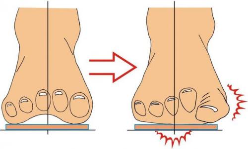 Косточка на ноге у мизинца. Можно ли вылечить данную патологию? 19
