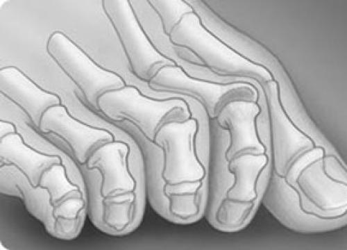 Деформация мизинца на ноге. Другие деформации 2, 3 и 4-го пальцев стопы