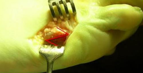 Деформация тейлора