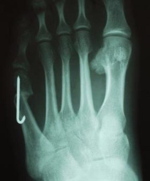 Косточка на ноге у мизинца. Можно ли вылечить данную патологию? 09