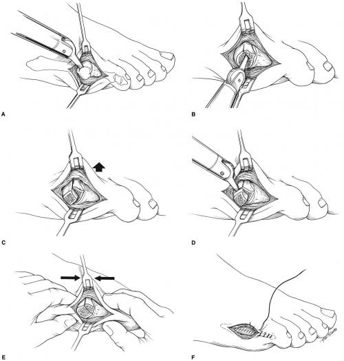 Косточка на ноге у мизинца. Можно ли вылечить данную патологию? 08
