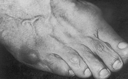 Косточка на ноге у мизинца. Можно ли вылечить данную патологию? 04