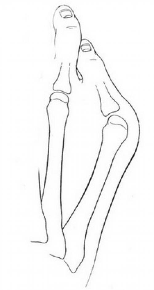 Косточка на ноге у мизинца. Можно ли вылечить данную патологию? 03