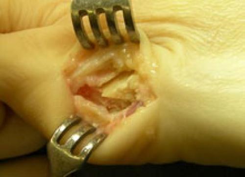 Деформация тейлора