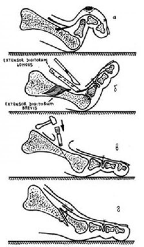 Деформация мизинца на ноге. Другие деформации 2, 3 и 4-го пальцев стопы