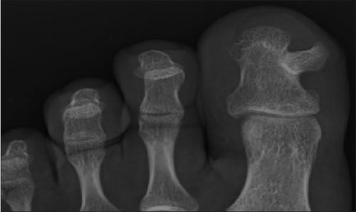 Подногтевой экзостоз или подногтевая остеохондрома. Что такое подногтевой экзостоз? 01 Подногтевой экзостоз или подногтевая остеохондрома. Что такое подногтевой экзостоз? 01