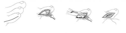 Косточка на ноге у мизинца. Можно ли вылечить данную патологию? 07