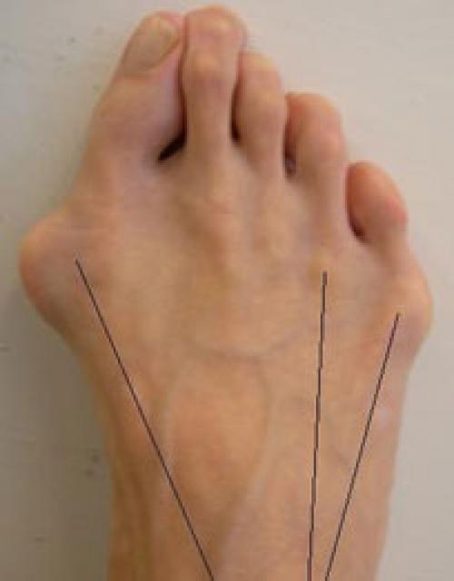 Деформация тейлора