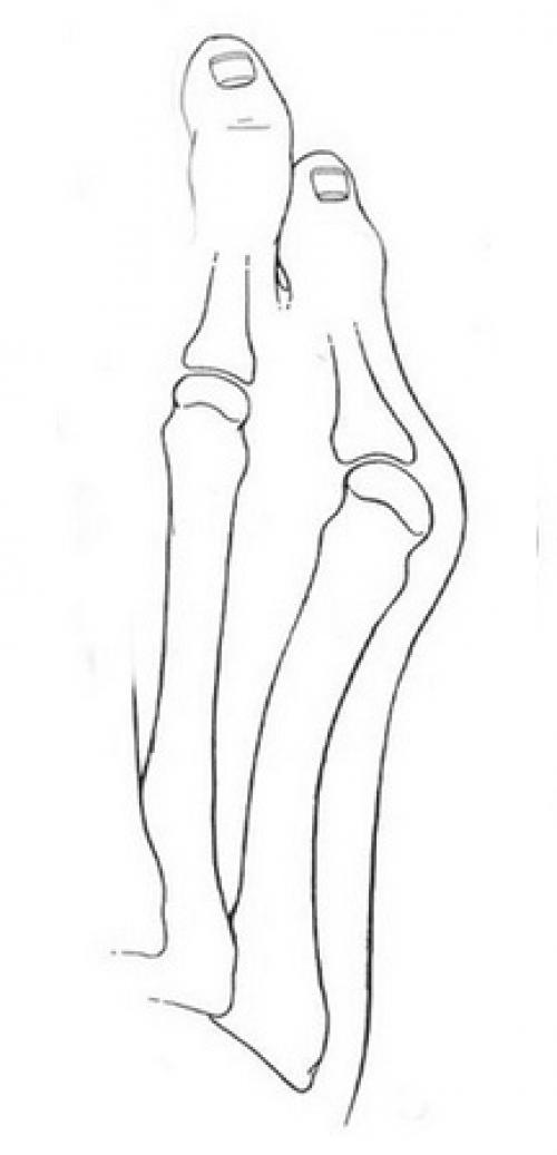 Косточка на ноге у мизинца. Можно ли вылечить данную патологию? 02