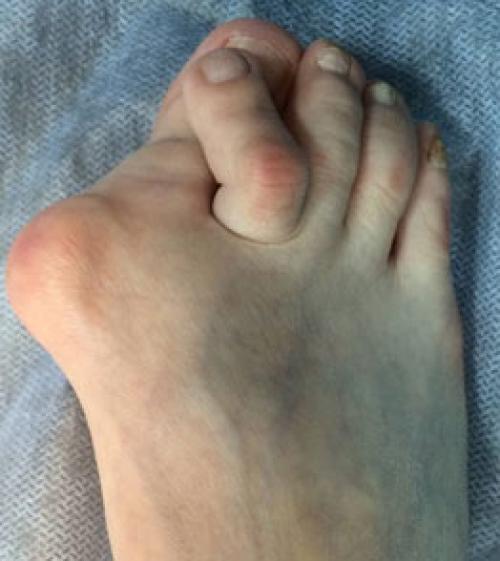 Деформация мизинца на ноге. Другие деформации 2, 3 и 4-го пальцев стопы