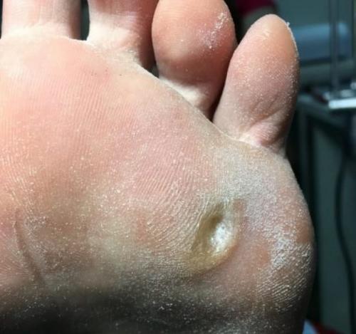 Мозолистые наросты на пальцах ног. Мозоль на стопе