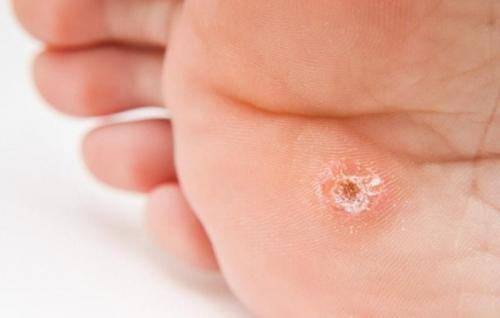 Шишка на пальце ноги похожая на мозоль, как убрать. Лопнула мозоль на ноге