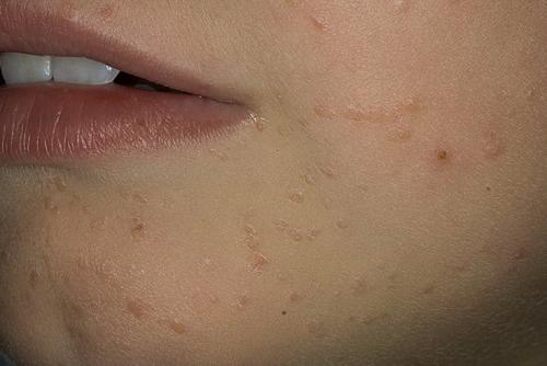 Бородавки на пальцах рук. Бородавки на руках: причины и лечение 06 Бородавки на пальцах рук. Бородавки на руках: причины и лечение 06