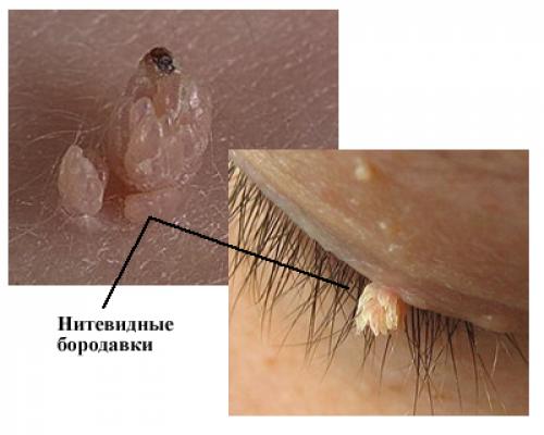 Бородавки на пальцах рук. Бородавки на руках: причины и лечение 08 Бородавки на пальцах рук. Бородавки на руках: причины и лечение 08