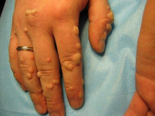 Бородавка на пальце руки с черными точками. Прошла бородавка