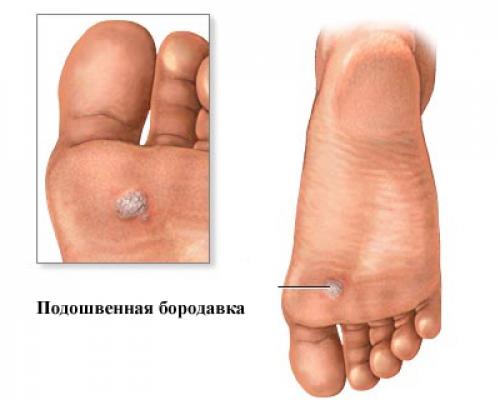 Бородавки на пальцах рук. Бородавки на руках: причины и лечение 07 Бородавки на пальцах рук. Бородавки на руках: причины и лечение 07