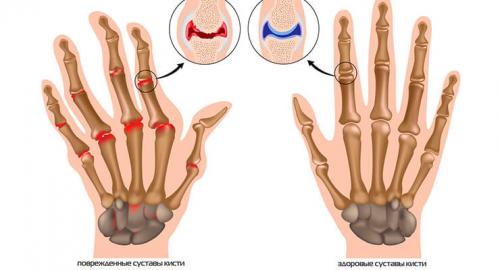 Желатин для суставов: народные рецепты и методы лечения 03 Желатин для суставов: народные рецепты и методы лечения 03