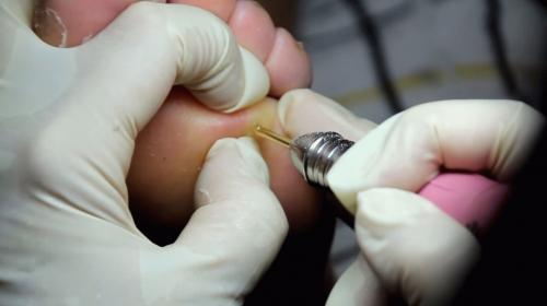 Мозолистый нарост. Внутренняя мозоль