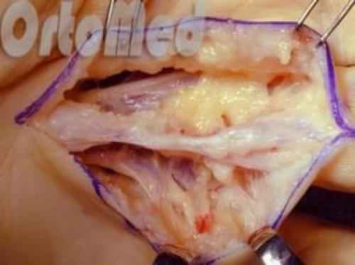 Лечение контрактура Дюпюитрена кисти. Симптомы 02 Лечение контрактура Дюпюитрена кисти. Симптомы 02