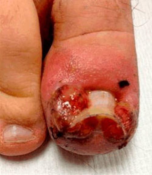 Доброкачественные опухоли ногтя и возле ногтя. Дикое мясо при вросшем ногте: эффективные способы лечения