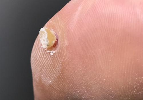 Шишка на пальце ноги похожая на мозоль, как убрать. Внутренняя мозоль