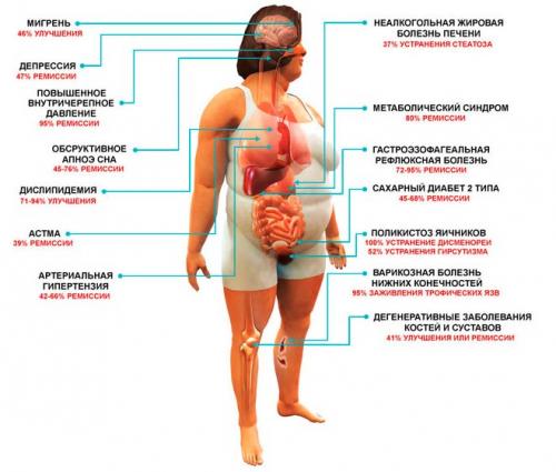 Как артроз коленного сустава влияет на качество жизни пожилых людей 03