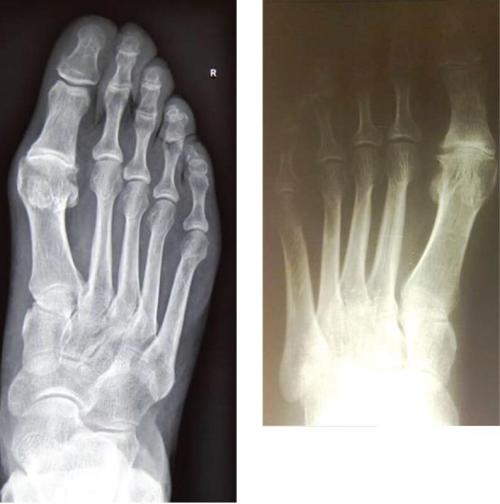 Артроз пальцев ног форум. The 1-st MTP joint severity deformity treatment