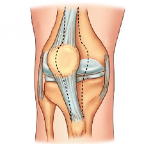 Виды травм коленного сустава и особенности их лечения. Повреждения коленного сустава 03