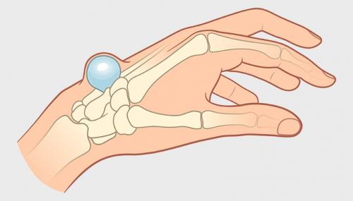 Появилась шишка на пальце руки и болит. Признаки гигромы тыла запястья 01 Появилась шишка на пальце руки и болит. Признаки гигромы тыла запястья 01