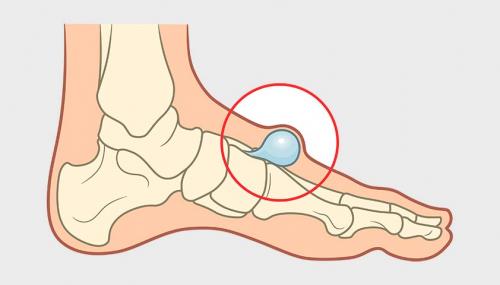 Появилась шишка на пальце руки и болит. Признаки гигромы тыла запястья 02 Появилась шишка на пальце руки и болит. Признаки гигромы тыла запястья 02