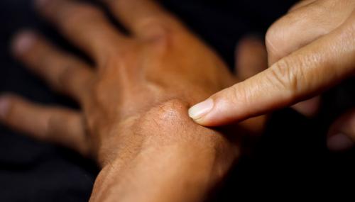 Появилась шишка на пальце руки и болит. Признаки гигромы тыла запястья 05 Появилась шишка на пальце руки и болит. Признаки гигромы тыла запястья 05