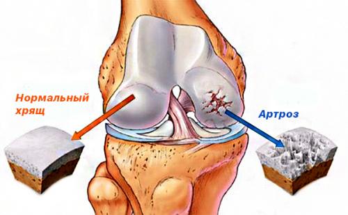 Проблемы и лечение деформирующего остеоартроза коленного сустава 01