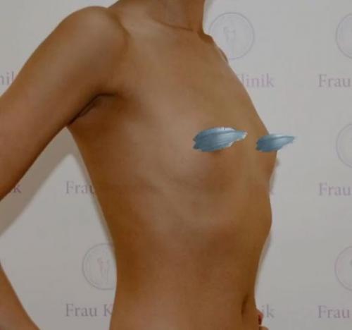 Соски в разные стороны. Асимметрия груди в подростковом возрасте 03 Соски в разные стороны. Асимметрия груди в подростковом возрасте 03