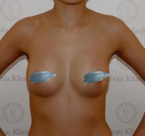 Соски в разные стороны. Асимметрия груди в подростковом возрасте 06 Соски в разные стороны. Асимметрия груди в подростковом возрасте 06