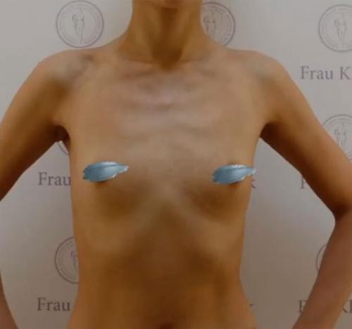 Соски в разные стороны. Асимметрия груди в подростковом возрасте 04 Соски в разные стороны. Асимметрия груди в подростковом возрасте 04