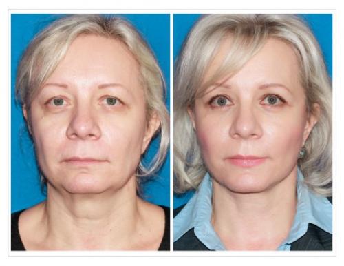 Уроки красоты. 
Как подтянуть веки и кожу вокруг глаз без операций? 

