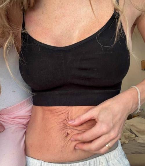 Анна хилькевич честно рассказала о том, как изменилась её кожа на животе после третьих родов.
