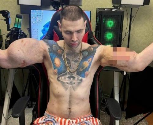 Бодибилдер Кирилл руки - базуки оказался на грани ампутации. 

