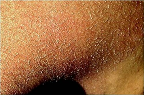 Уроженка фиджи столкнулась с кожными высыпаниями, которые начали беспокоить её ещё три года назад.  