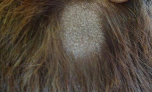 Уроженка фиджи столкнулась с кожными высыпаниями, которые начали беспокоить её ещё три года назад. 01