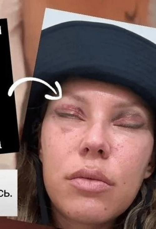 В прошлом году Рита дакота решилась лечь под нож пластического хирурга и сделала блефаропластику, но операция прошла неудачно. 01