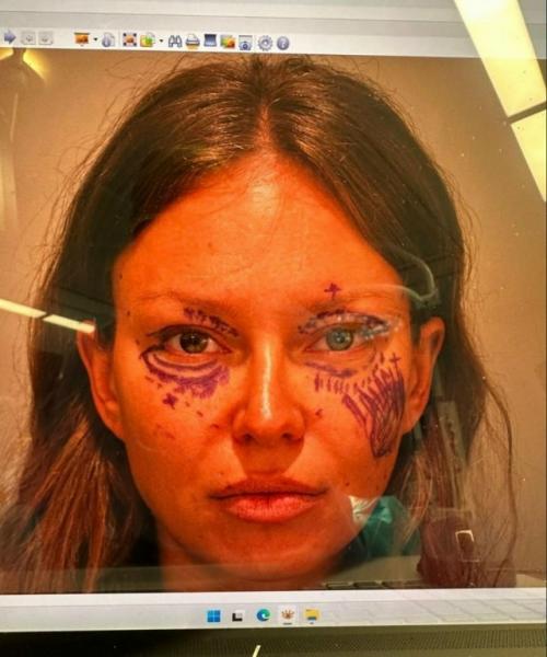 В прошлом году Рита дакота решилась лечь под нож пластического хирурга и сделала блефаропластику, но операция прошла неудачно. 02