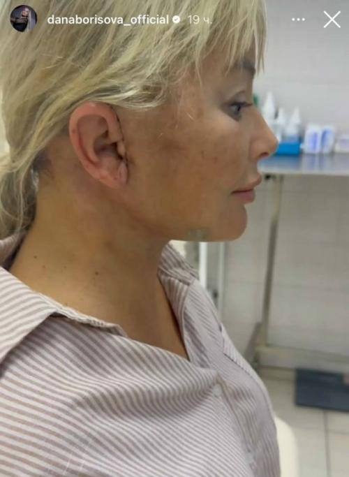 49-Летняя дана Борисова показала результаты очередной пластической операции. 02