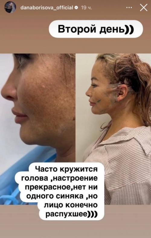 49-Летняя дана Борисова показала результаты очередной пластической операции. 03